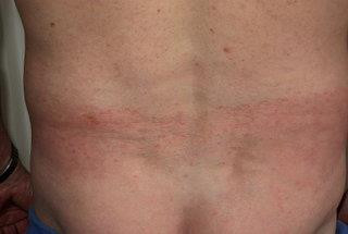 Grzybica skóry gładkiej - objawy, rozpoznanie, leczenie, zdjęcia