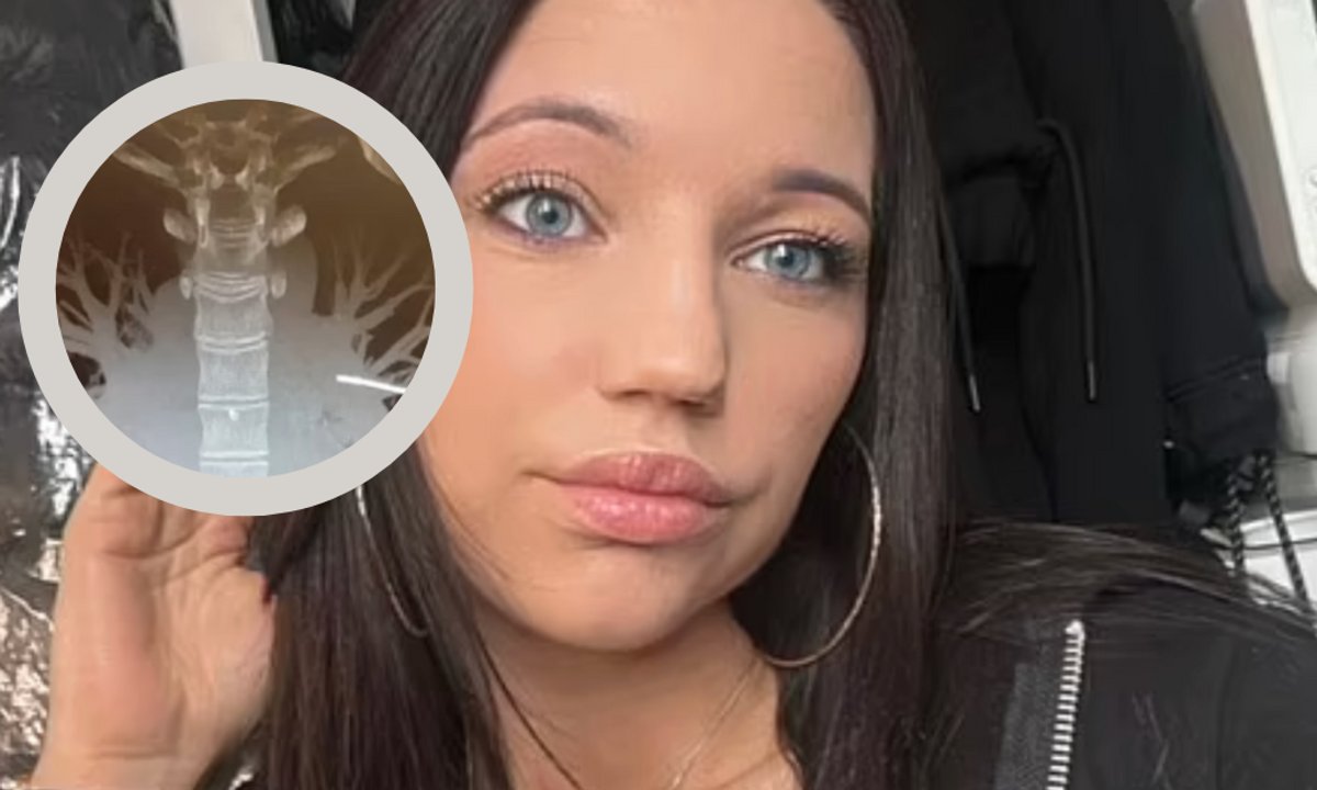 Chciała usunąć implant antykoncepcyjny. Lekarze ze strachem odkryli, gdzie się przemieścił