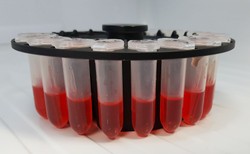 Morfologia pomaga wykryć białaczkę szpikową. Liczy się regularne badanie