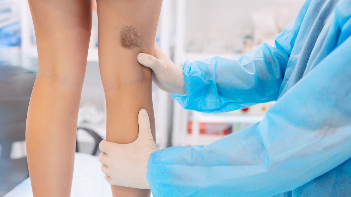 Mesta na telu i znaci da su neobjašnjive modrice simptom bolesti