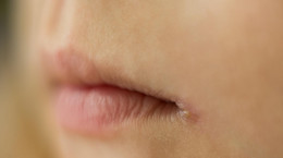 Zapalenie kącików ust - przyczyny, objawy, leczenie i profilaktyka