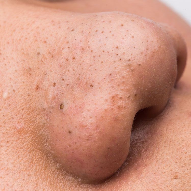 12 Bumps On Your Skin That Are Totally Normal—and You Shouldnt Pop