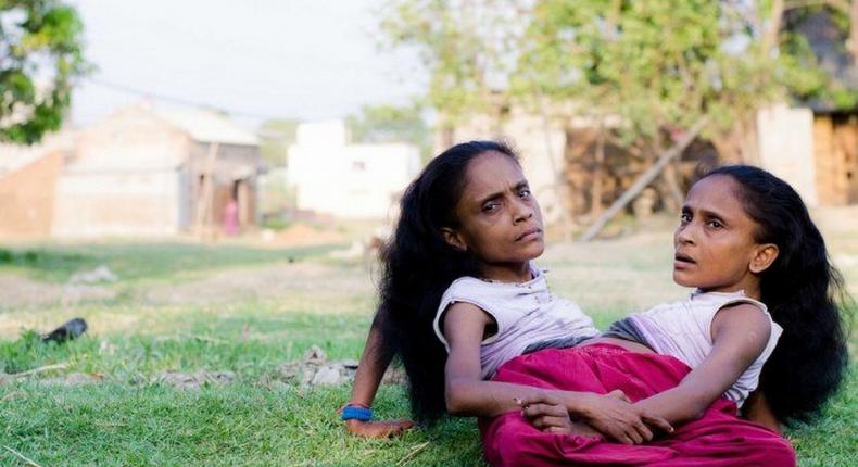 After 46 years of looking for love conjoined twins Ganga and Jamuna Mondal popularly known as 'The Spider Sisters' have finally found love with the same man.