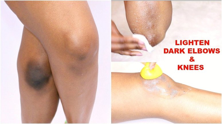 Here are 5 ways to naturally get rid of dark elbows and knees