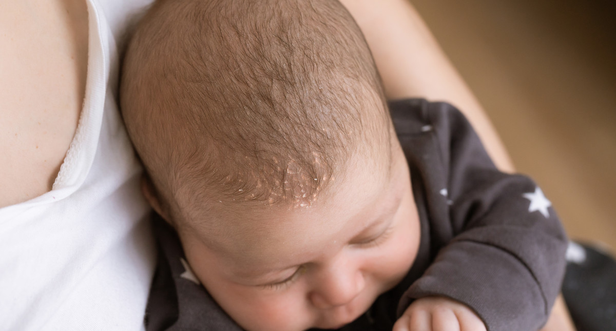 Łojotokowe zapalenie skóry u niemowląt - objawy, leczenie