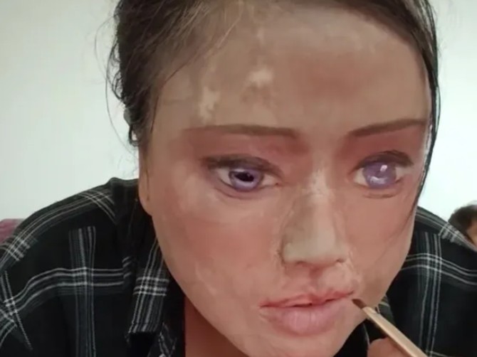 "Oči crtam šminkom jer svoje više nemam": Ispovest žene koju je muž polio kiselinom