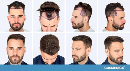 Przeszczep włosów: ceny, kliniki, gdzie i jak go wykonać? - forbes -  Forbes.pl
