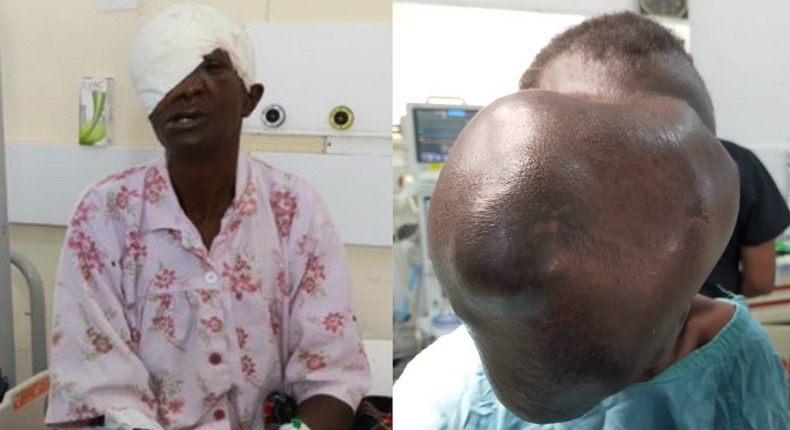 Moi Teaching & Referral Hospital removes cystic growth that covered Beatrice Makokha’s face