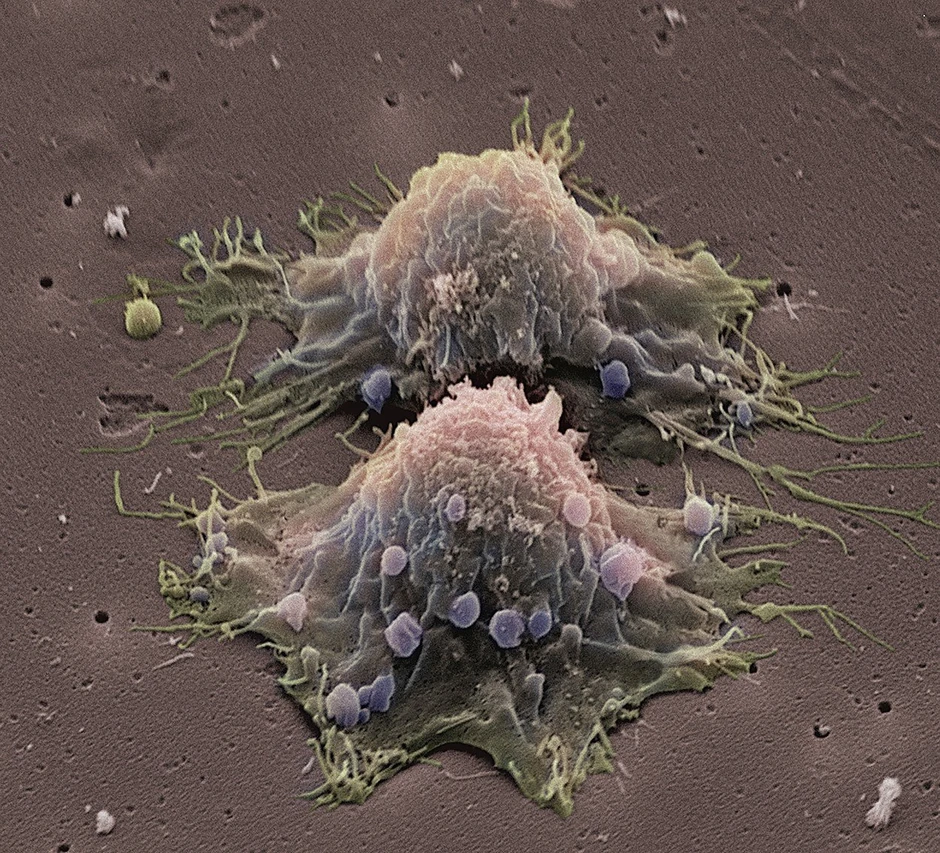 Grupe kanceroznih ćelija bile su previše male da se uoče na testovima (foto: ilustracija)