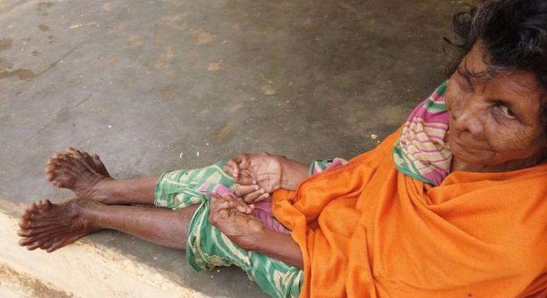 Woman with 31 fingers and toes chooses to live indoors as she’s branded a witch