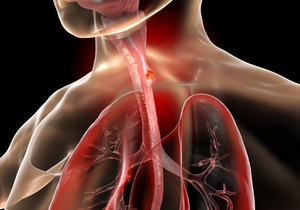 Pacijenti bez vidljivog Barrett-ovog jednjaka imali su uznapredovali rak u istraživanju 