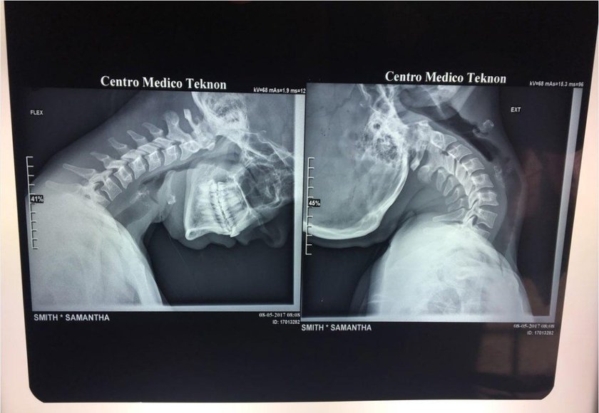 Cierpi na rzadką chorobę. To dzieje się z jej szyją