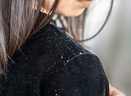 Miért korpásodik jobban a fejbőr hideg időben? című cikk nyitóképe