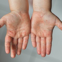 Láz és fájdalmas kiütések - újabb betegség terjed a gyerekek között