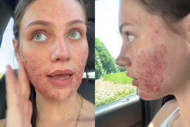 Lice joj je bilo PREKRIVENO AKNAMA, a onda je odlučila da stavi BOTOKS i svi su ZAPANJENI šta se desilo - slike PRE I POSLE dermatologe ostavile u potpunom čudu