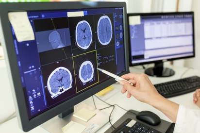 Új kapuk nyíltak meg az agydaganat diagnosztizálására: így növelheti a túlélési arányt