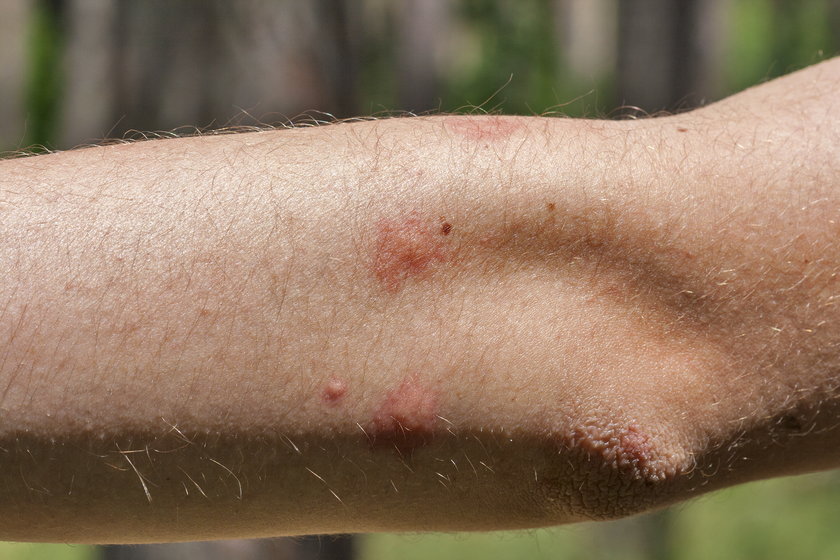 Komary powodują bolesne ukąszenia, które swędzą. Warto zastosować któryś z domowych sposobów, by się przed nimi bronić