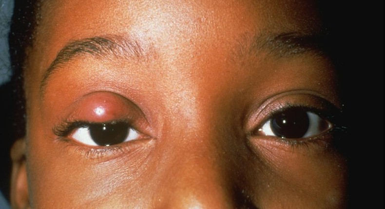 how to treat stye(North Texas Eye Center)