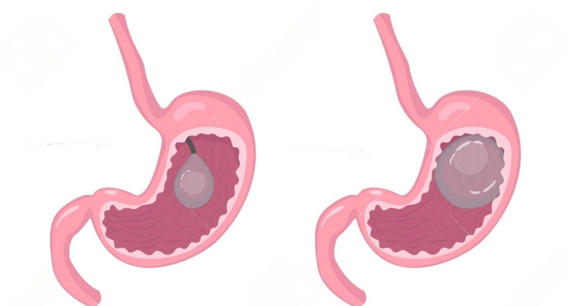 Nonsurgical weight loss in Kenya The Gastric Balloon journey