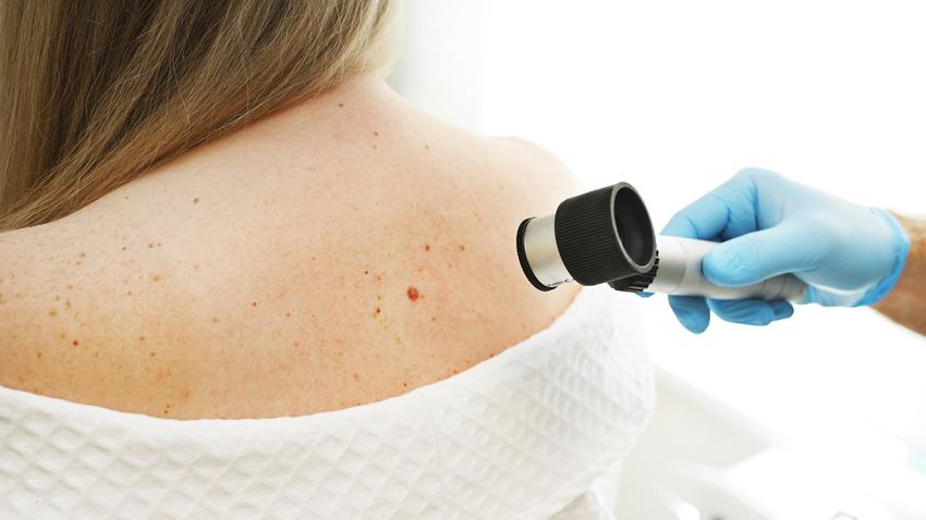 melanoma diagnózis kérdés orvos