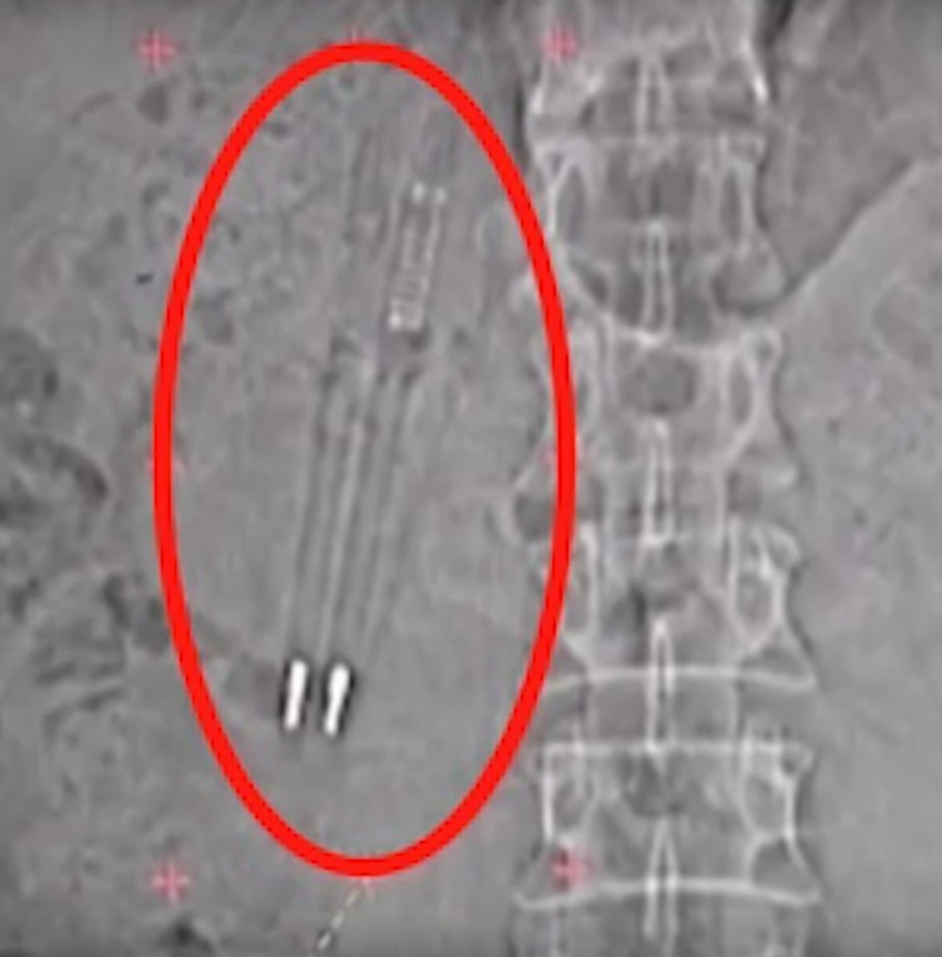 Kinezi su imali sličan slučaj