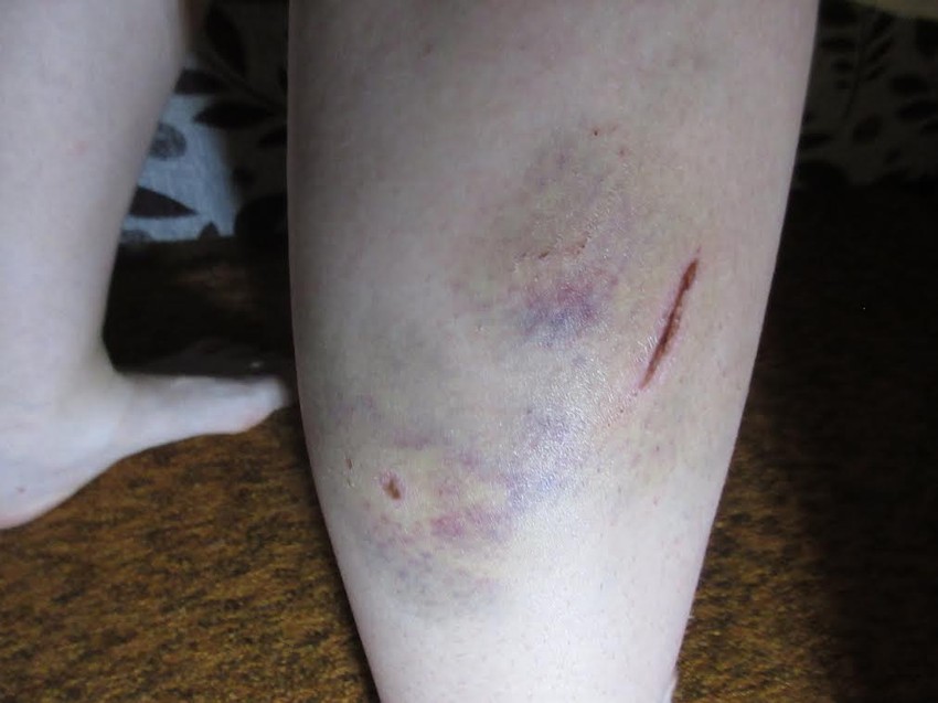 Ugriz psa na Vesninoj nozi