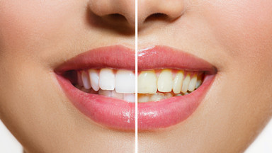 Jak to, co jesz wpływa na twoje zęby