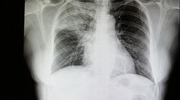 Zapalenie płuc - choroba dziadków i wnuków