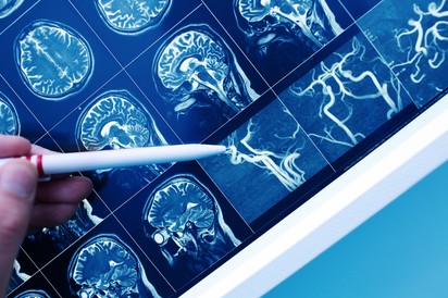 Magyar felfedezés mutathat új irányt a stroke és a demencia gyógyításában