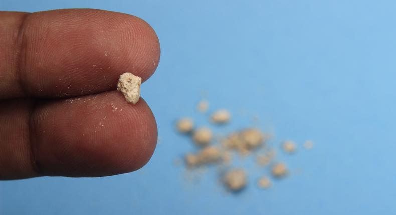 What are kidney stones?