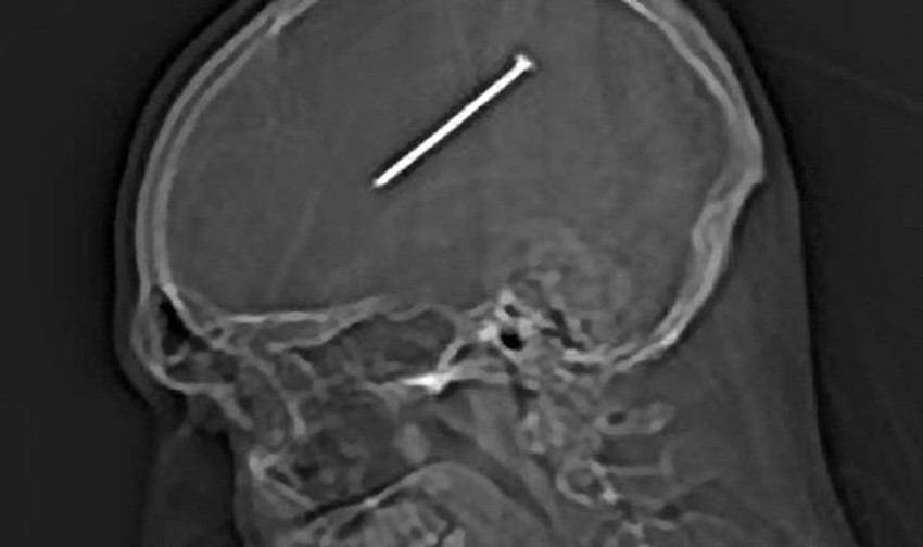 Rendgenski snimak otkrio ekser u glavi Dantea Atula