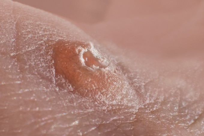 A bél baktériumflórája is segíthet a HPV legyőzésében - ezeket tartsa be!