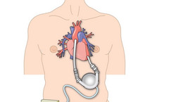 Życie z niewydolnością serca. Czym są LVAD?