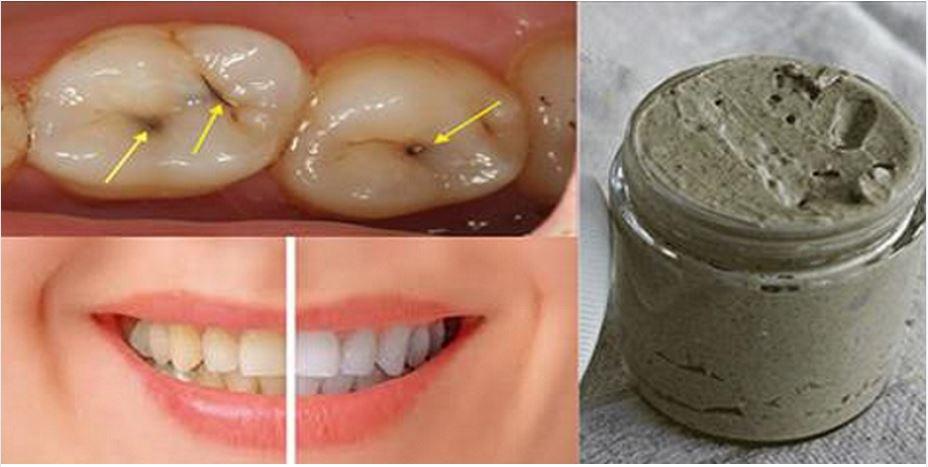Cseréld le a fogkrémedet! Ez a tartalmas házi készítésű fogkrém véd a fogszuvasodástól, meggyógyítja az ínybetegséget, és kifehéríti a fogakat