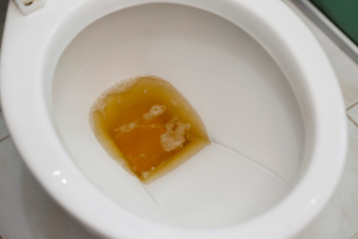 Ochorenie pečene môže spôsobiť stmavnutie moču, a to aj napriek dostatočnej hydratácii.