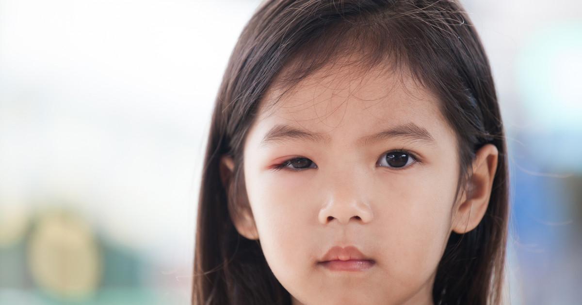 Podpuchnięte oko u dziecka: co robić? Przyczyny, domowe sposoby, alergia -  Dziecko
