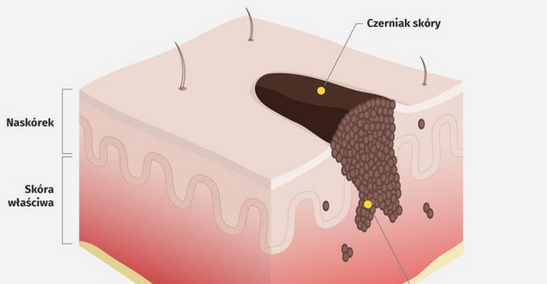 Czerniak Skóry Wszystko Co Musisz Wiedzieć O Tym Nowotworze Infografika 9475
