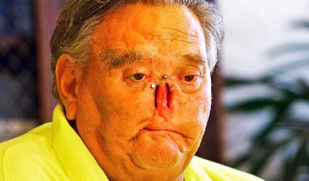 James Davis prežil hrozivý útok dvoch šimpanzov.