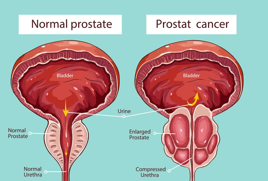 Normalna prostata i rak prostate