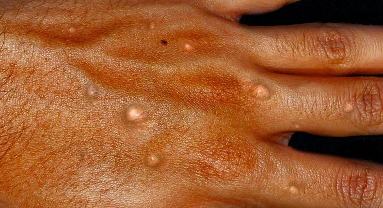 Monkeypox on a hand-Healthdirect