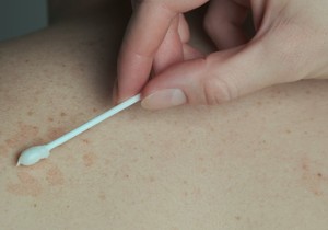 Bris kože može da pomogne u dijagnostici Parkinsonove bolesti