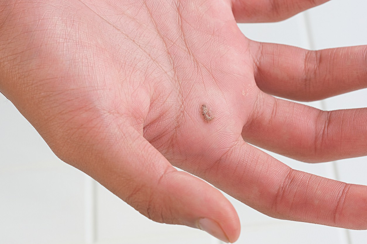 Jedným z najhorších nápadov je domáce vyrezávanie, vypaľovanie alebo prepichovanie bradavíc.