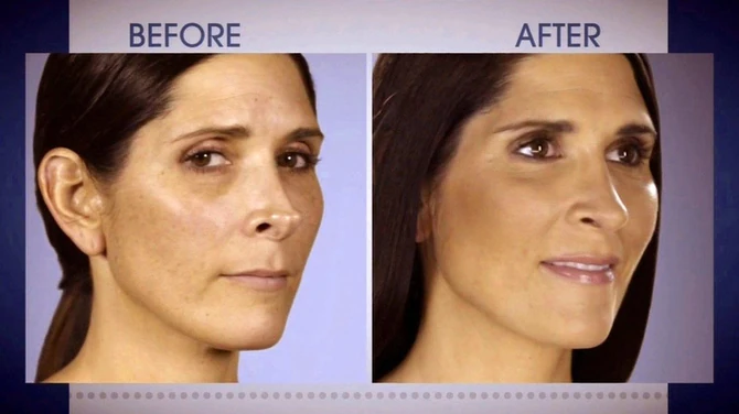 Nos za koji je rekla da liči na štipaljku i nov nos koji je dobila nakon druge operacije