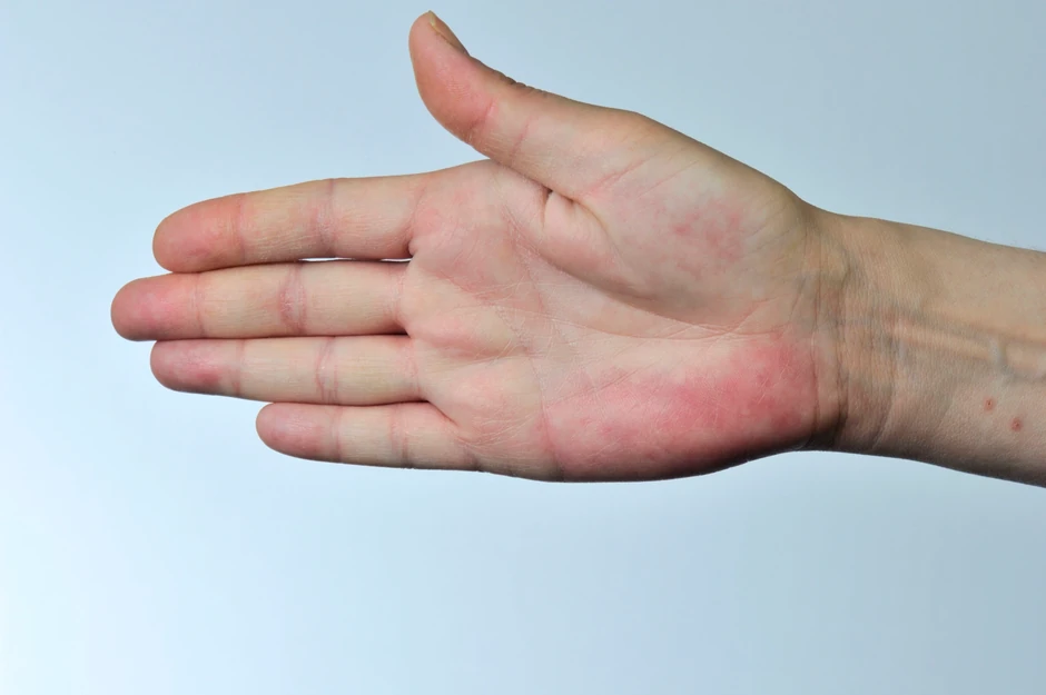Crvenilo usled palmarne eriteme može da podseća na osip