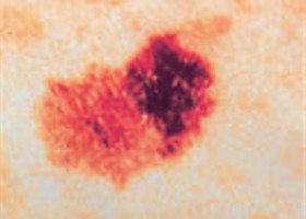 melanoma-280-d000008F249f1db5c7baa