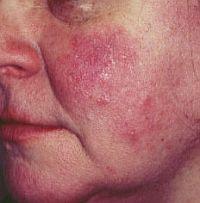 az úgynevezett kötőszövet bőrbetegsége