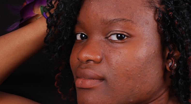 5 natural ways to get rid of acne scars and pimple marks