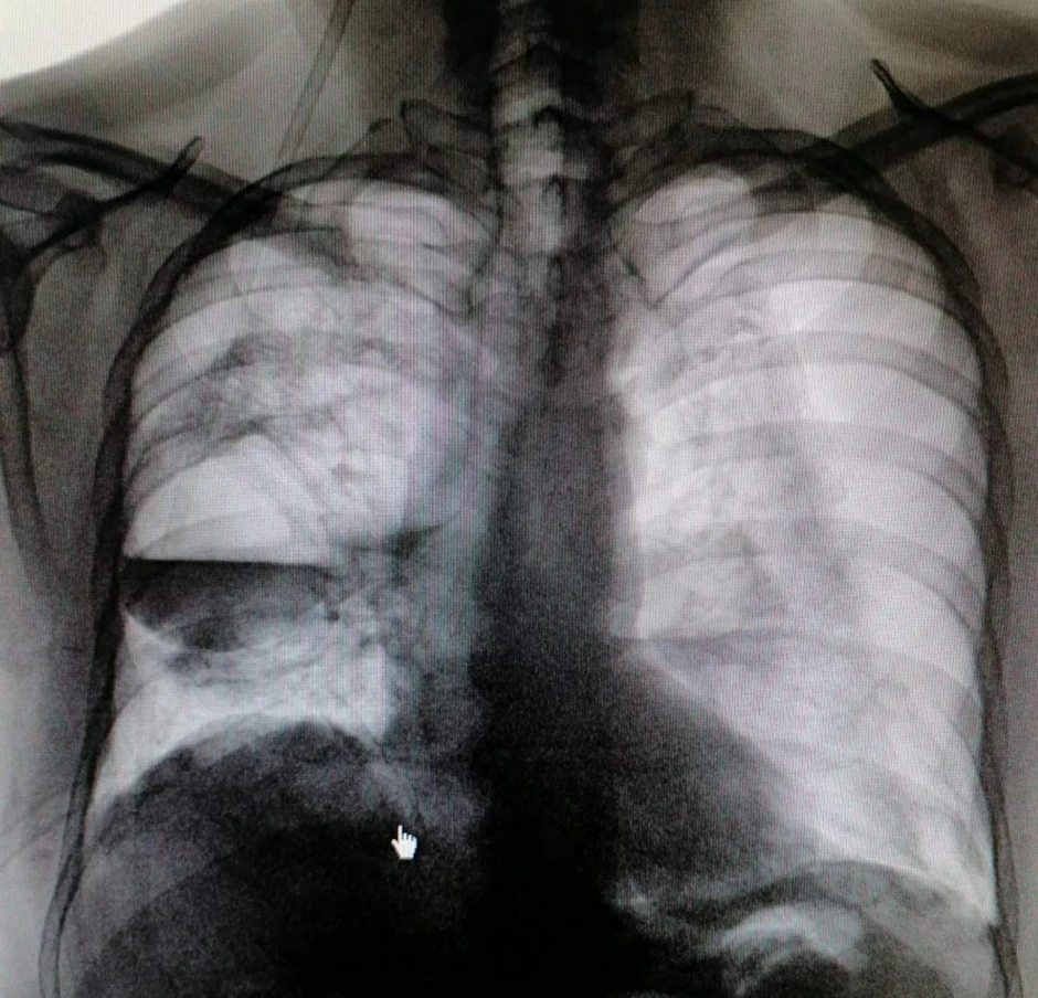 Obostrani pneumotoraks sa apscesnom šupljinom