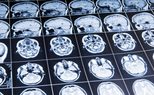 Leki steroidowe mogą powodować zmiany w strukturze mózgu [BADANIA]