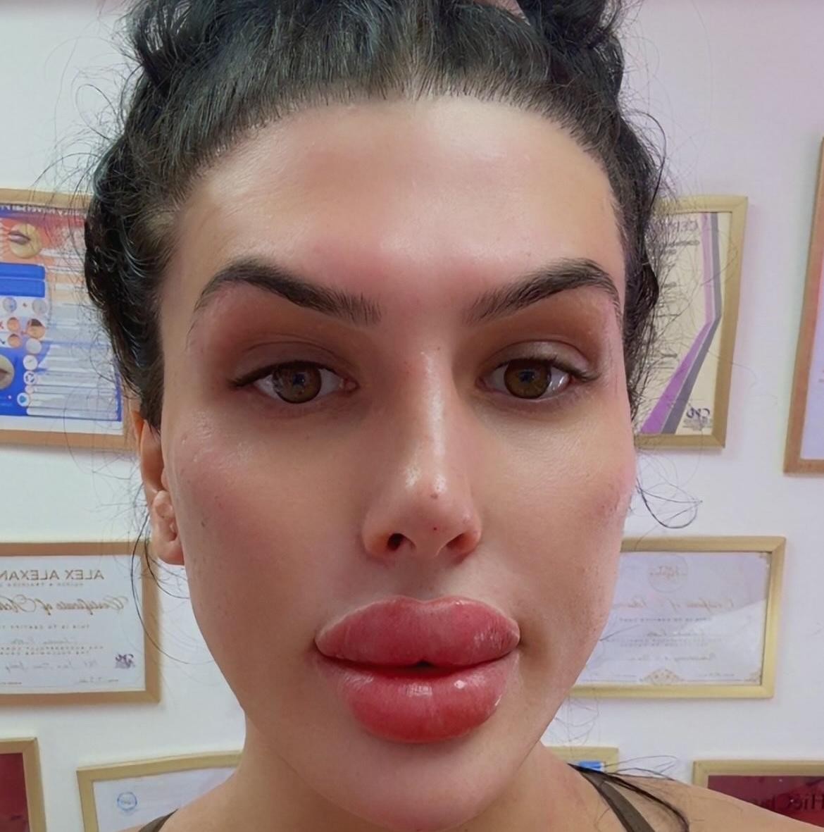 Sofia Lips túži po titule ženy s najväčšími perami v Británii.